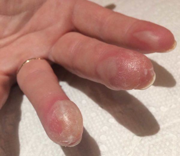 Chili second degree Burns